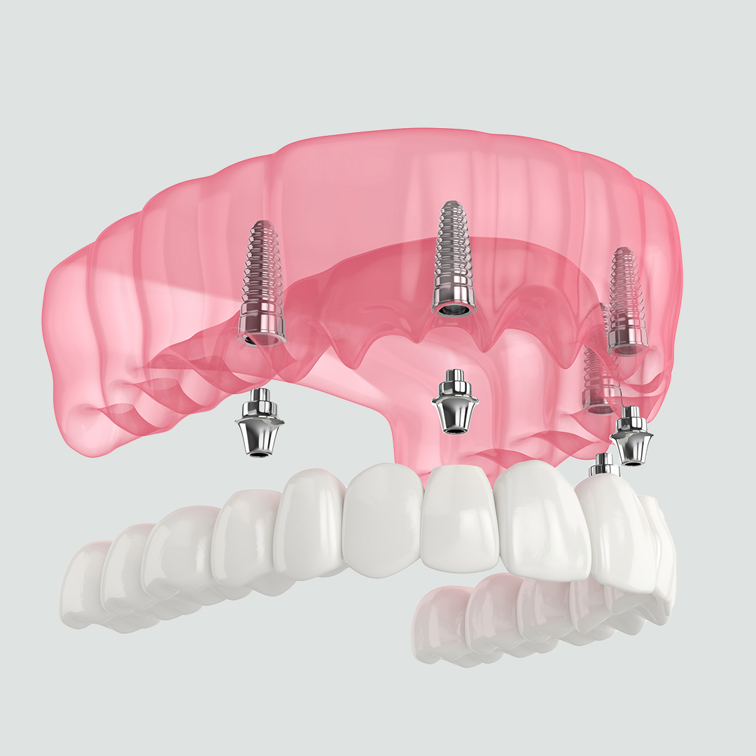 https://dentaresklinik.com/wp-content/uploads/2023/01/All-on-4-implants.jpg
