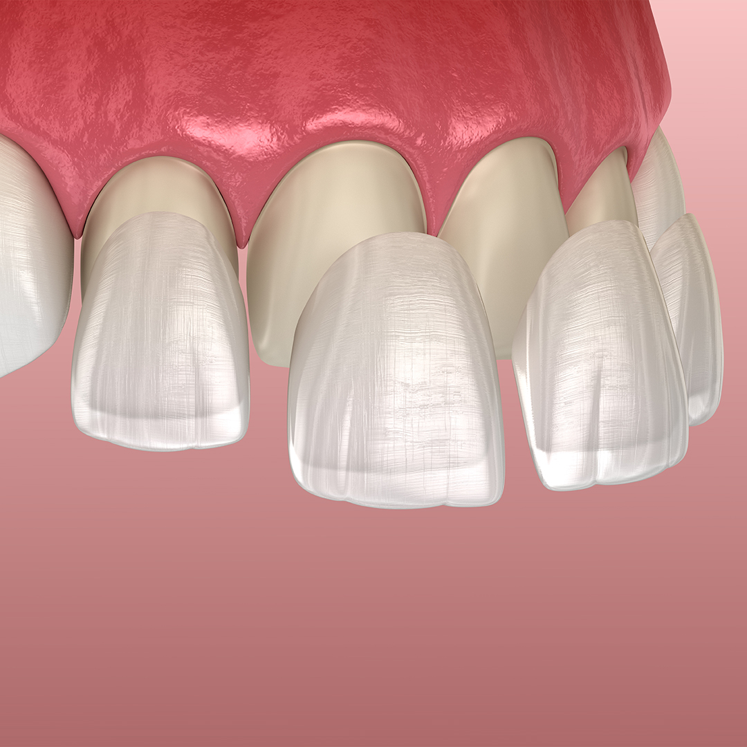 https://dentaresklinik.com/wp-content/uploads/2023/01/Dental-Lumineers2.jpg