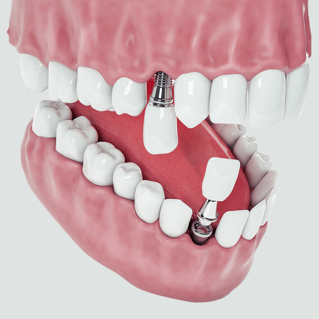 https://dentaresklinik.com/wp-content/uploads/2023/01/DentalImplantTurkeys.jpg