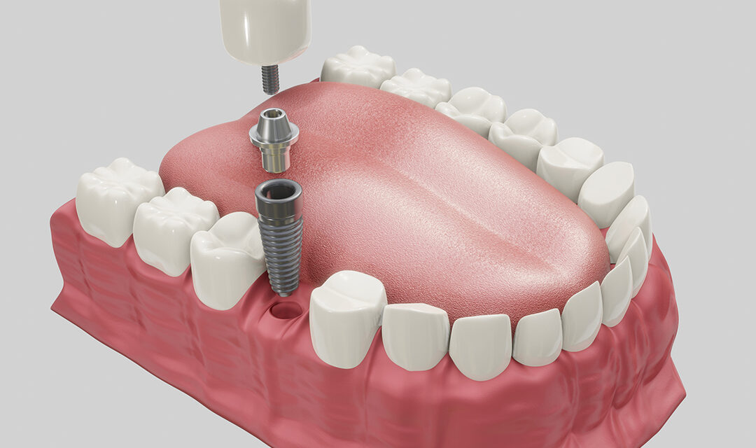 How Much Are Dental Implants In Turkey?