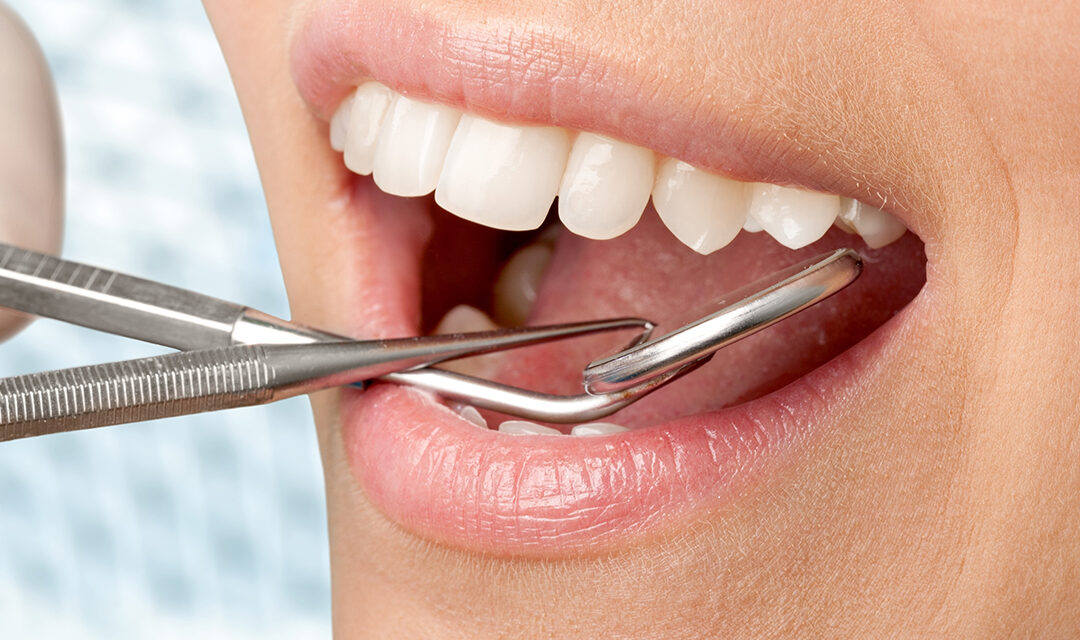 How To Get Your Teeth Done In Turkey?